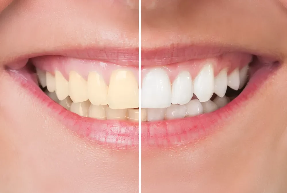 Teeth Whitening in Wilmington, DE: What to Expect from Professional Treatment