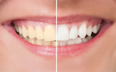 Teeth Whitening in Wilmington, DE: What to Expect from Professional Treatment