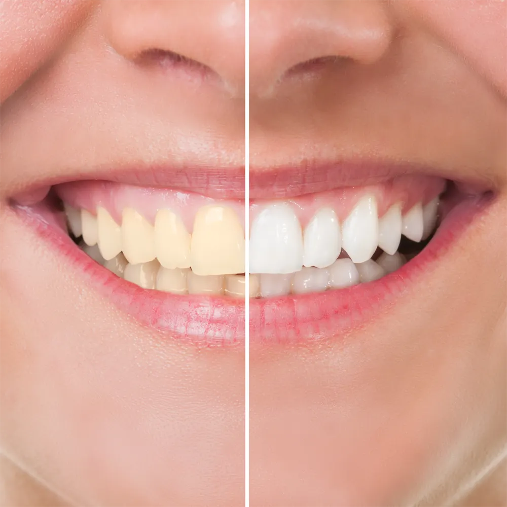 Common Questions about Teeth Whitening in Wilmington
