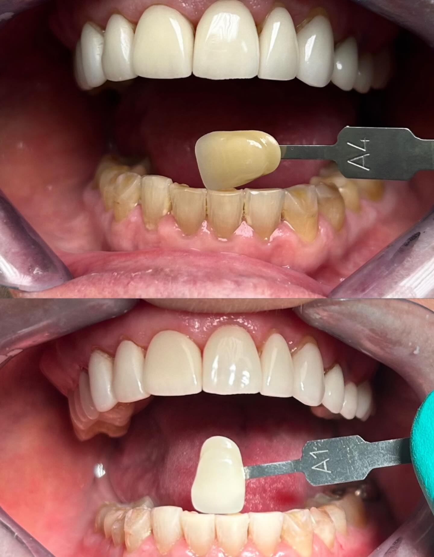 Whitening