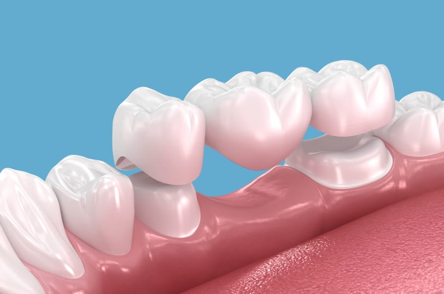Dental Bridges in Wilmington, DE