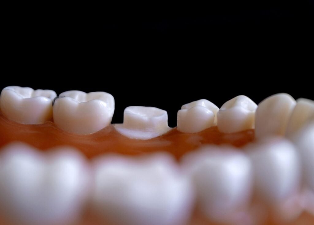Close-up of dental treatment comparing root canal therapy and tooth extraction